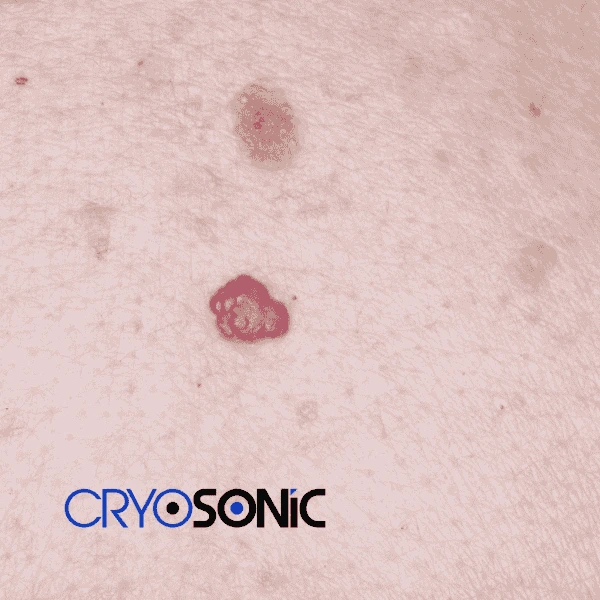 Looking for pain free cherry angioma removal treatment Wakefield? Call our team today! Wakefield