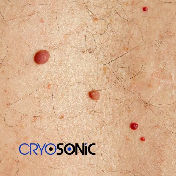 get cherry angioma removal treatment today! Wakefield