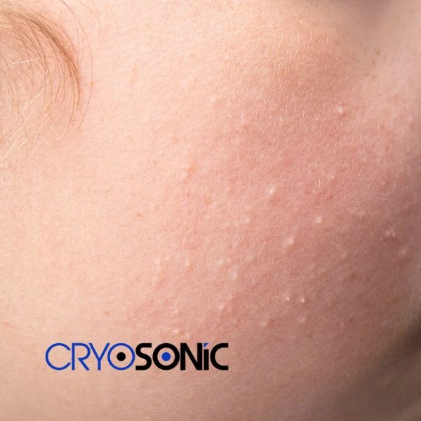 Are you looking for milia removal treatment? Contact our team today Wakefield