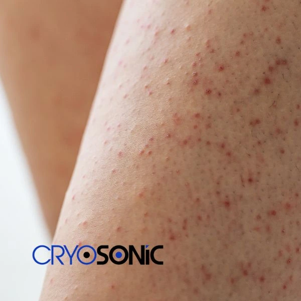 Looking for Seborrhoeic Keratosis removal Wakefield treatment? Call our consultants today in Wakefield