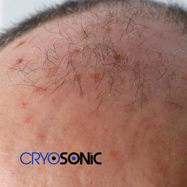 Access Seborrhoeic Keratosis removal from the comfort of your own home! Call us today in Wakefield