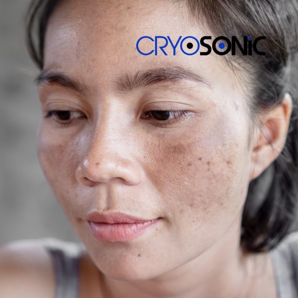 Ready to start age spots removal? Contact our team today in Wakefield