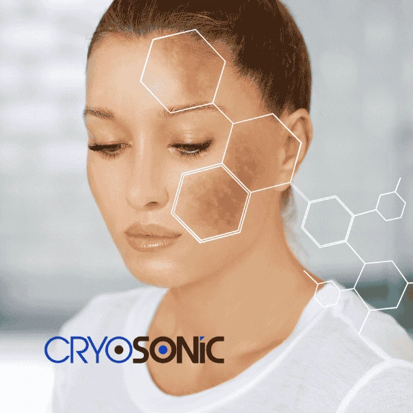 Are you looking for age spot removal treatment? Contact Cryosonic today in Wakefield