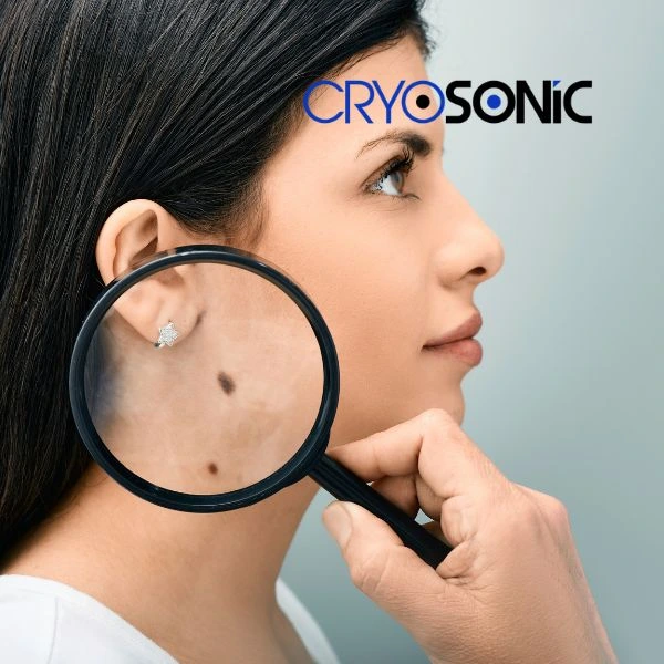 Do you want to learn more about benign moles removal treatment? Call our team today Wakefield