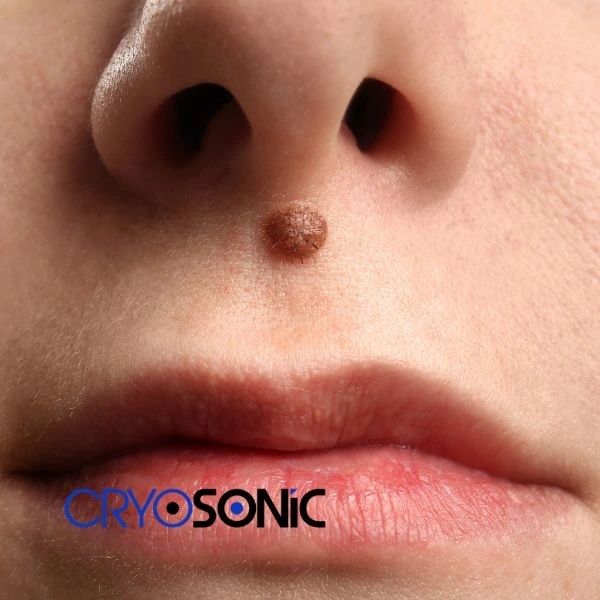 Start your benign moles removal treatment today Wakefield