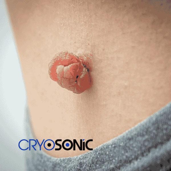 Book your skin tags removal Wakefield from comfort of your own home! Wakefield