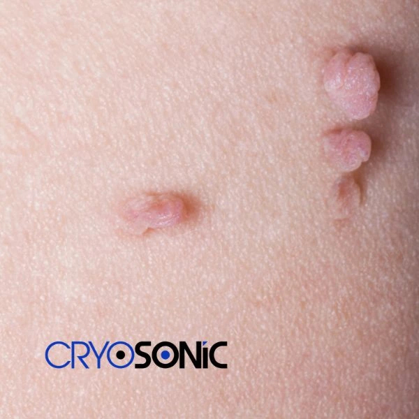 Are you looking for fast effect skin tag removal Wakefield? Book in NOW! Wakefield