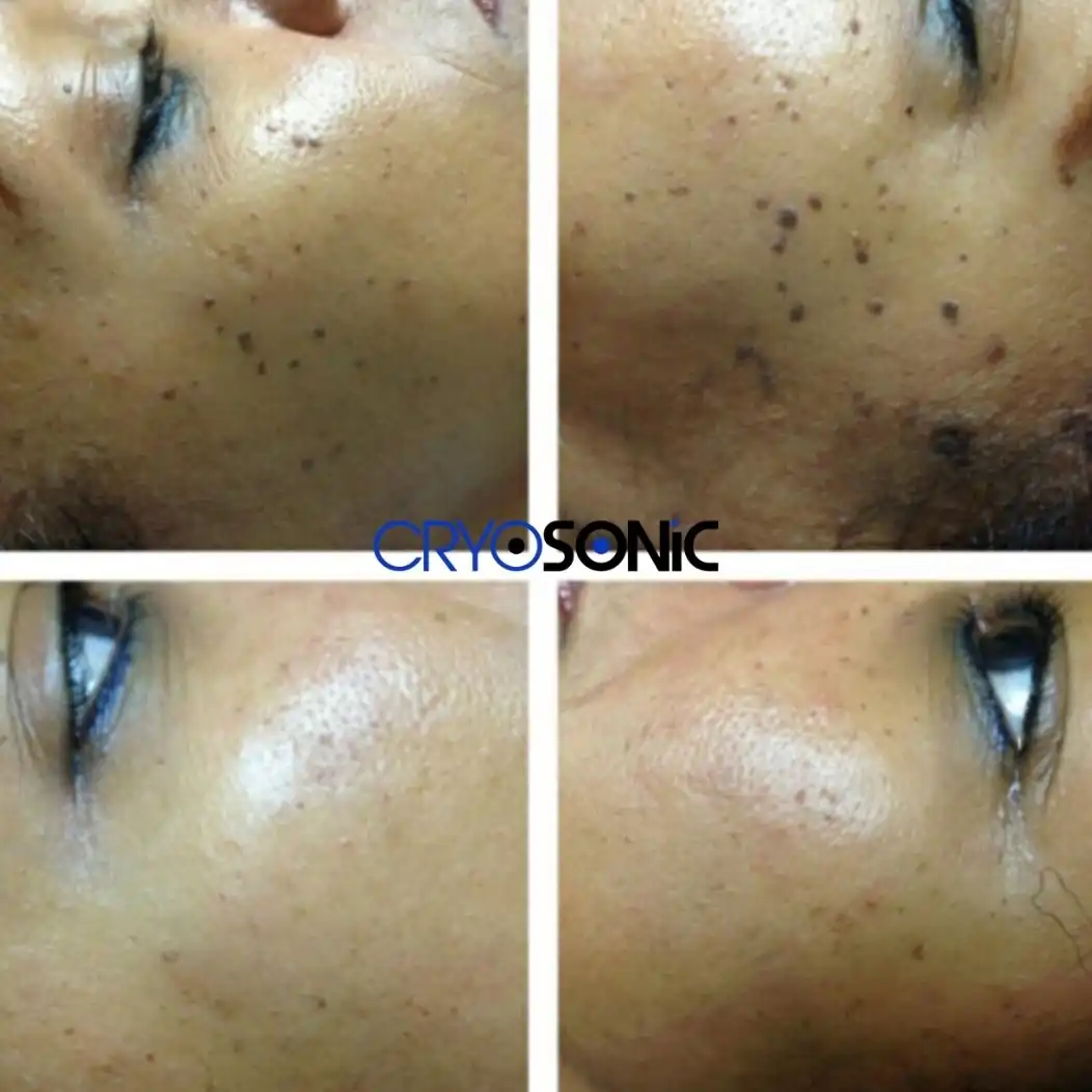 Why Skin Shows Pigmentation After Treatment Wakefield