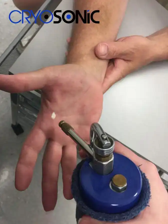 Temperature Differences: OTC vs Medical-Grade Cryotherapy Wakefield